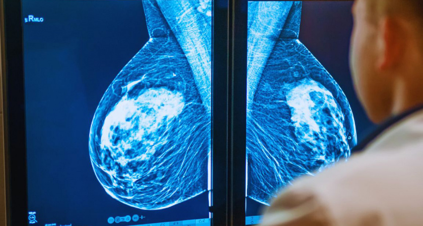 Раннее выявление рака в ходе диспансеризации спасло жизнь вологжанке 