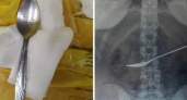 Вологодские врачи извлекли из желудка пациентки металлическую ложку
